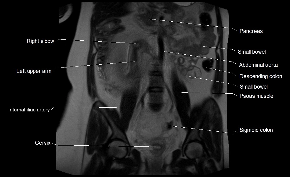 MRI Anatomy of pregnancy image 20.webp